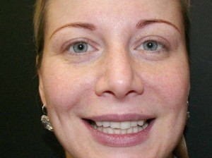 Porcelain Veneers–Wheaton Before