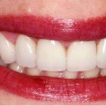 Gummy smile-Gum lift-Porcelain veneers--Wheaton patient