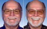 Cosmetic Dental implant Bridge & Crowns-Glen Ellyn