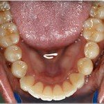 Invisalign--Severe Lower Tooth Crowding --Glen Ellyn Patient