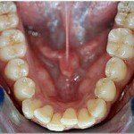 Invisalign--Severe Lower Crowding --Glen Ellyn