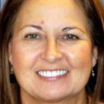 Dental Implant Bridges-Porcelain Veneers-Wheaton patient