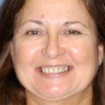 Dental Implant Bridges-Porcelain Veneers-Wheaton patient