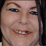 Dental implant Crown Front Tooth-Porcelain Veneers-Naperville Patient