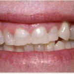 Gummy smile-Laser Gum lift-Porcelain Lumineer Veneers--Lombard patient