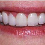 Gummy smile-Laser Gum lift-Porcelain Lumineer Veneers--lombard patient