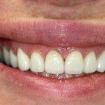 Gummy smile-Laser Gum lift-Porcelain veneers--Wheaton patient