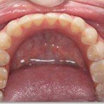 Invisalign--Crowded lower front teeth glen ellyn