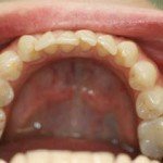 Invisalign--Crowded lower front teeth--Glen ellyn patient