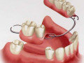 Removable-Partial-Denture glen Ellyn Wheaton