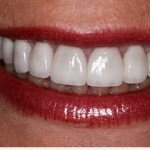 Porcelain Veneer to cover Tetracycline stain glen ellyn cosmetic dentist