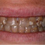 Porcelain Veneer to cover Tetracycline stain glen ellyn cosmetic dentist