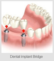 implantbridge1