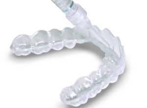 alternatives of tooth whitening glen ellyn wheaton