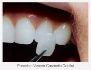 veneer1