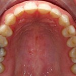 Invisalign--Spaces Gaps between Front Teeth Wheaton patient