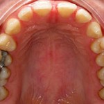 Invisalign--Spaces gaps between front teeth Wheaton patient