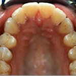 Invisalign--"Bucked" Protruded Front Teeth Glen Ellyn Patient