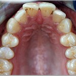 Invisalign--"Bucked" Protruded Front Teeth glen ellyn