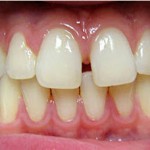 Invisalign--Gaps Spaces Front Teeth Before