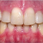 Invisalign--severe crowding glen Ellyn Patient