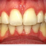 Invisalign-- Gaps Crowded Teeth Glen Ellyn