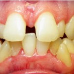 Invisalign-- gaps crowded teeth glen elllyn