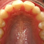 Invisalign--Gaps and "Buck" Front Teeth--Glen Ellyn