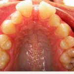 Invisalign--Gaps and "Buck" Teeth--Glen Ellyn
