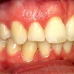 Invisalign-- Flared "Buck" Teeth --Wheaton patient