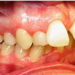 Invisalign-- Flared "Buck" Teeth --Wheaton patient