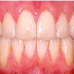 Invisalign--Open Bite Front Teeth Buck teeth After