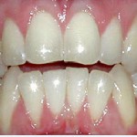 Invisalign--Glen Ellyn Open Bite Front Teeth Buck teeth